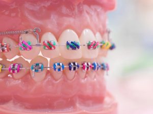 Brackets de colores: cómo elegir la mejor combinación