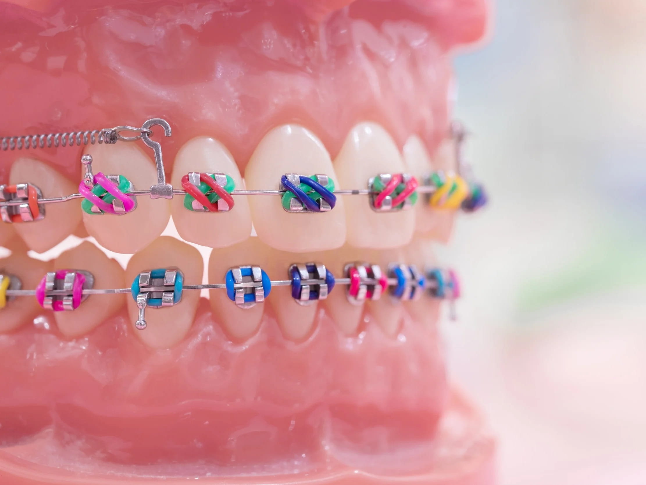 Brackets metálicos con gomitas de colores