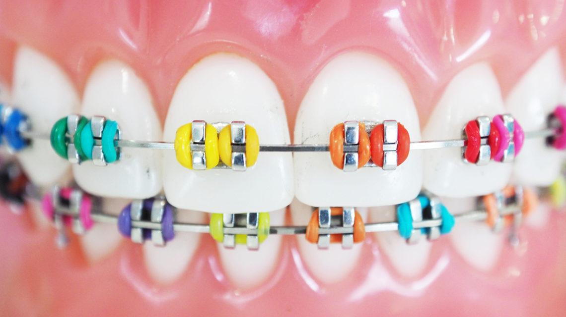 Brackets con ligaduras de colores