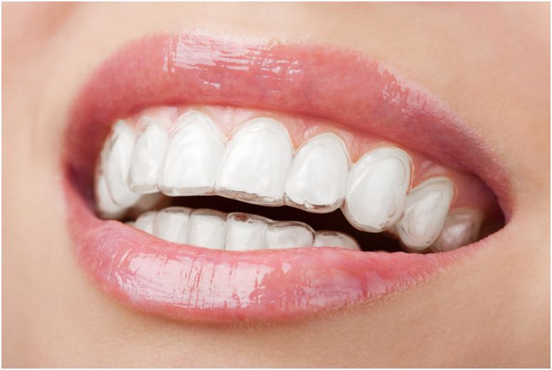 Прозрачные элайнеры Invisalign и Impress