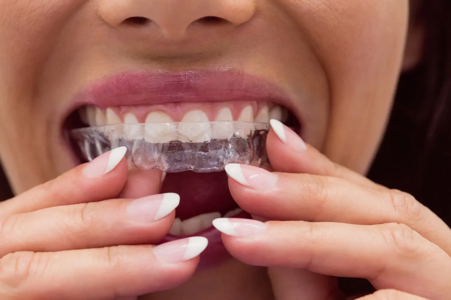 Элайнеры Impress и Invisalign: сравнение прозрачных кап